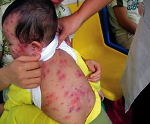 C&acirc;n nhắc giữa lợi &iacute;ch v&agrave; những điều kh&ocirc;ng mong muốn của vaccine 1