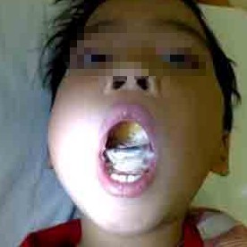 Lưỡi của bé Nhật Ánh biến dạng sau tai nạn.