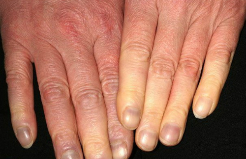 Ngón tay tê, chuyển màu trắng (đỏ) và lạnh là dấu hiệu của hội chứng Raynaud. 