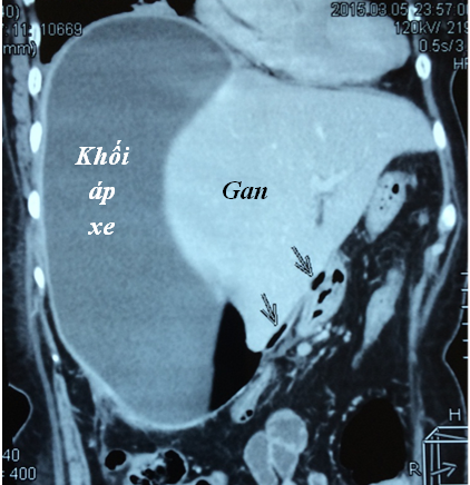 Hình ảnh chụp cắt lớp điện toán trước mổ, hình ảnh khí từ lỗ thủng hành tá tràng.