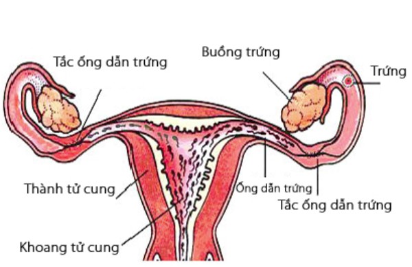 tắc ống dẫn trứng