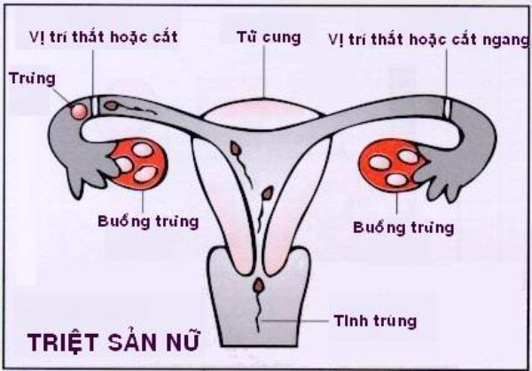 thắt ống dẫn trứng 