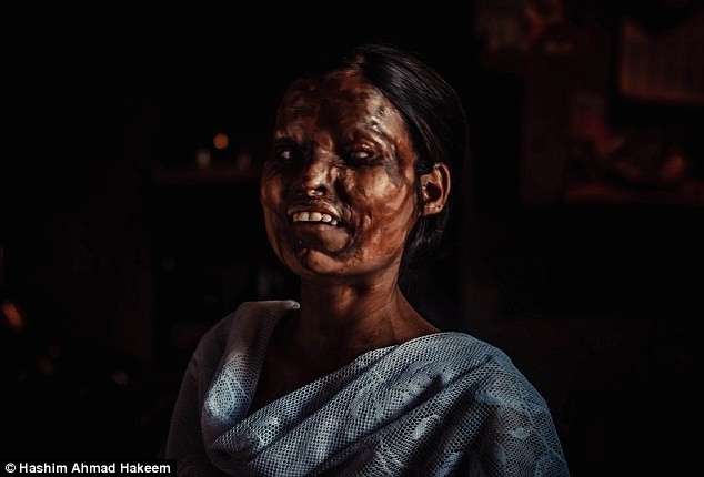Ký ức kinh hoàng của những cô gái bị tạt axit ở Ấn Độ