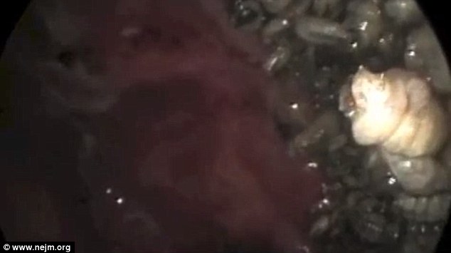 Hơn 100 con dòi sinh sống trong khoan mũi của một bệnh nhân 65 tuổi