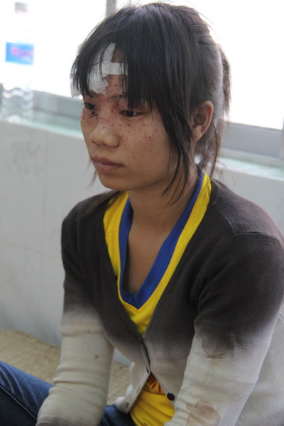 Chị Dương Thị Hồng Nhung bị thương ở vùng mặt đang điều trị tại bệnh viện Hàm Thuận Nam. Ảnh: Hoàng Trường