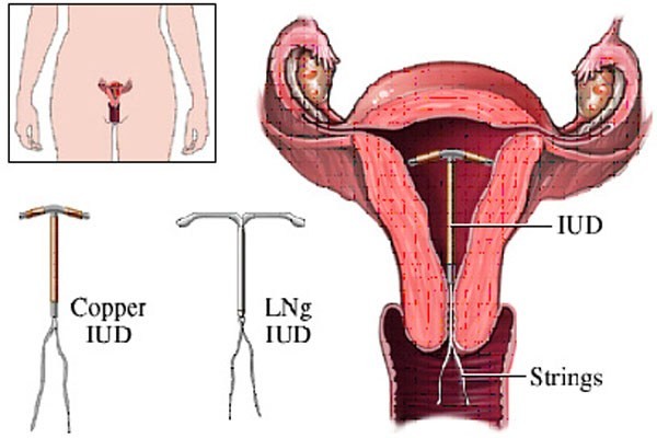 Nó dùng được cho những người chống chỉ định với estrogen, không ảnh hưởng đến cơ chế đông máu, huyết áp, chuyển hóa, không gây u nội mạc tử cung. Tuy nhiên, nó có thể gây mụn trứng cá hoặc u nang buồng trứng ở phụ nữ. IUD là phương pháp ngừa thai hiệu quả đối với hầu hết phụ nữ, bao gồm cả những người bị béo phì. Hiệu quả của phương pháp này lên đến 99%.
