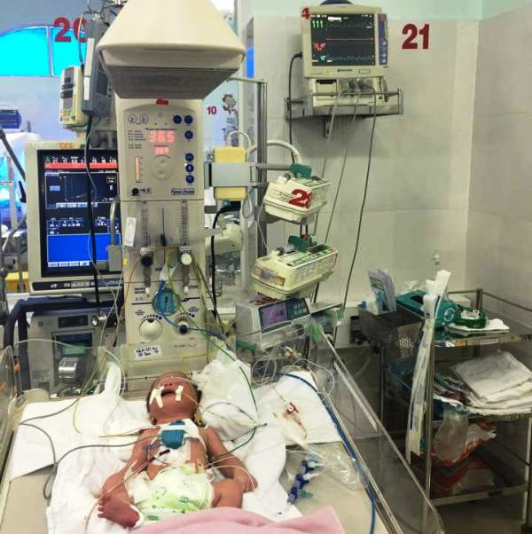 Bé sống sót kỳ diệu khi thở chậm trong bụng mẹ suốt thai kỳ đang được chăm sóc tại khoa Hồi sức sơ sinh BV Nhi Đồng 2 sau khi được đặt máy tạo nhịp tim.