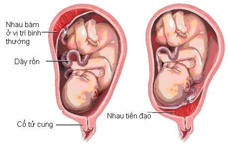 Nhau bám thấp là một dạng nhẹ của nhau tiền đạo. Nhau tiền đạo là tình trạng bánh nhau không bám ở đáy tử cung mà một phần hay toàn thể bánh nhau bám ở đoạn dưới cổ tử cung. Ảnh: mecuti.vn