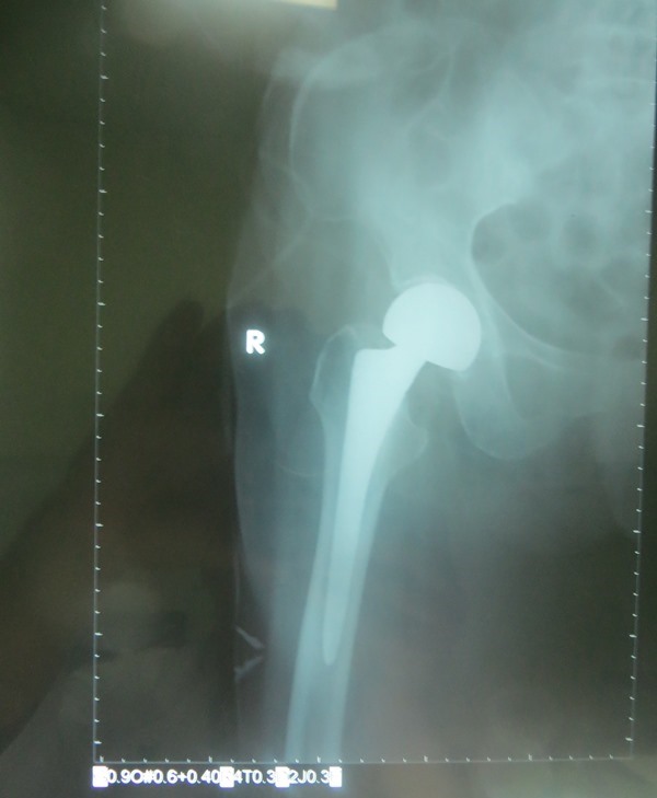 
Hình ảnh phim x-quang của bệnh nhân Nguyễn Thị G. (đã được phẫu thuật thay khớp háng bán phần). Ảnh: Đ.H
