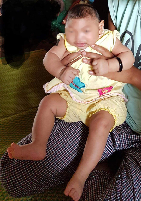 
Bé gái 4 tháng tuổi ở Krông Búk, Đắk Lắk đã được xác định là mắc chứng đầu nhỏ. Ảnh: NLĐ
