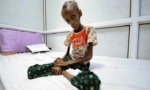 
Ảnh Saida Ahmad Baghili nằm viện vì suy dinh dưỡng nặng do đói ăn chụp hồi đầu tuần. Ảnh: CNN
