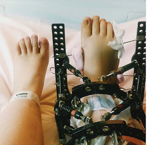 C&ocirc; g&aacute;i quyết định phẫu thuật k&eacute;o d&agrave;i ch&acirc;n. Ảnh: SWNS.