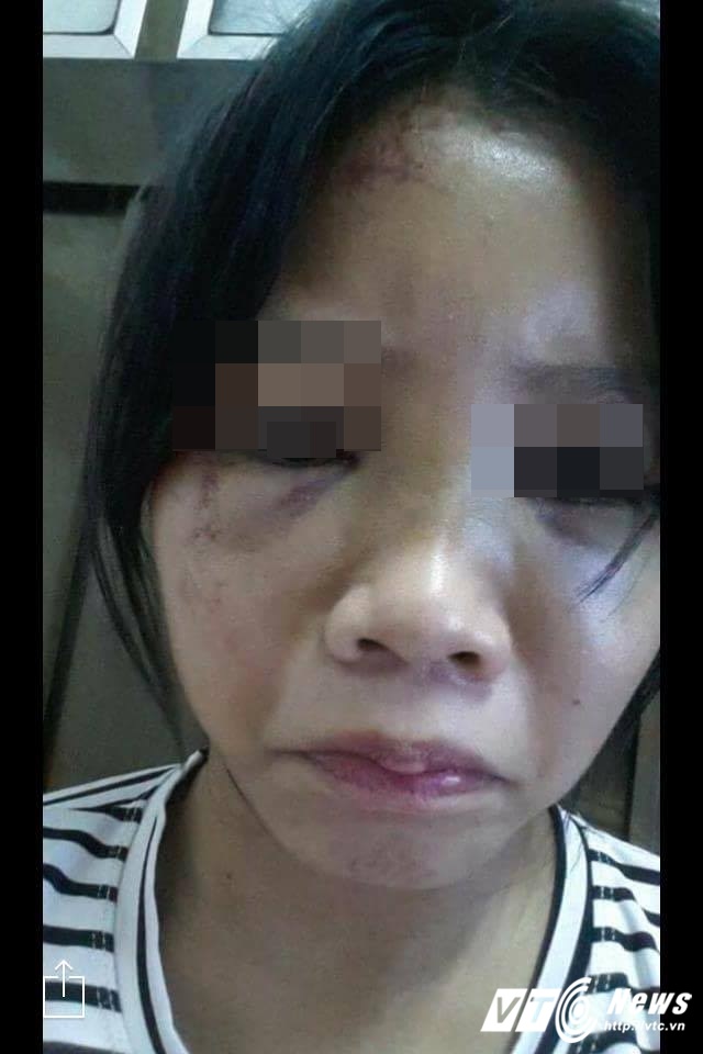 
H&igrave;nh ảnh nữ sinh V. T. T. U sau khi bị h&agrave;nh hung một tuần.
