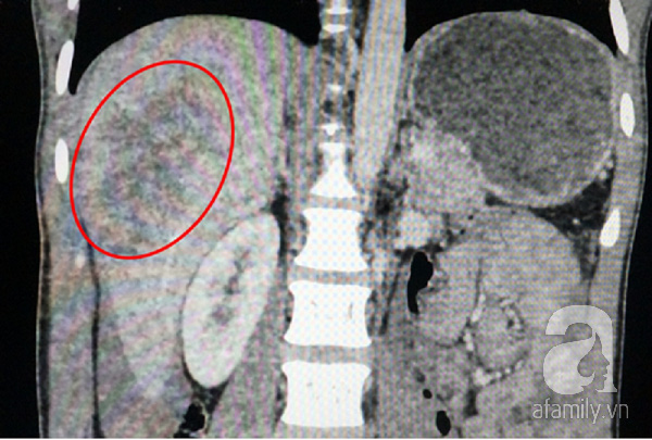 
Ảnh chụp CT cho thấy phần gaa anh T. bị vỡ. (Ảnh: Bệnh viện cung cấp)
