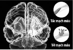 Đột quỵ não đang có xu hướng xảy ra ở người trẻ tuổi.