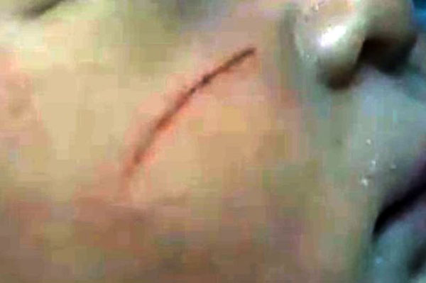 
Vết cắt do dao cứa trên mặt bé gái sơ sinh khiến gia đình không khỏi thương xót. Ảnh: AsiaWire
