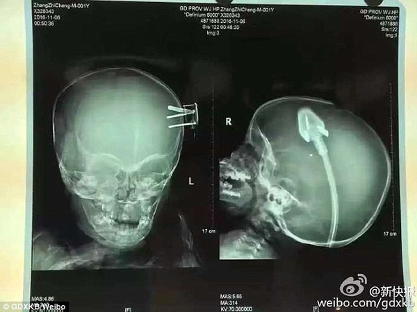 
Phim chụp cho thấy 3 chân của phích cắm đã ở sâu bên trong đầu của cậu bé.
