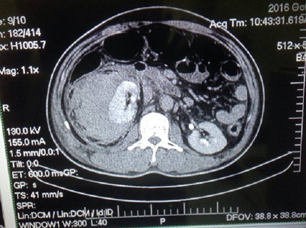 Hình ảnh cắt lớp vi tính sau can thiệp ngưng chảy máu