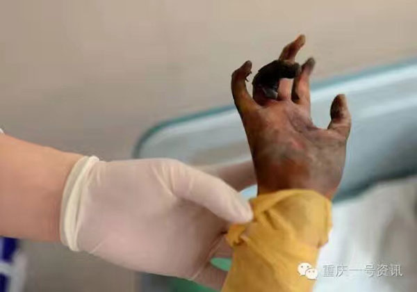 
Bàn tay nhỏ bé bị cháy đen của Jiajia. Ảnh: China Daily
