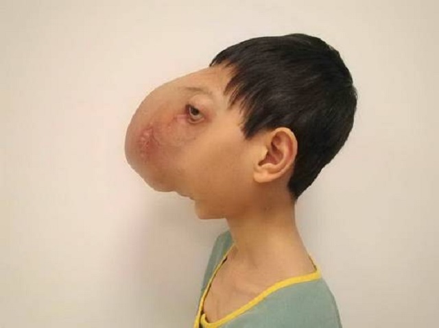 Em Lê Trung Tuấn từng bị khối u che hết khuôn mặt và bị ảnh hưởng tới khả năng nghe, nhìn.