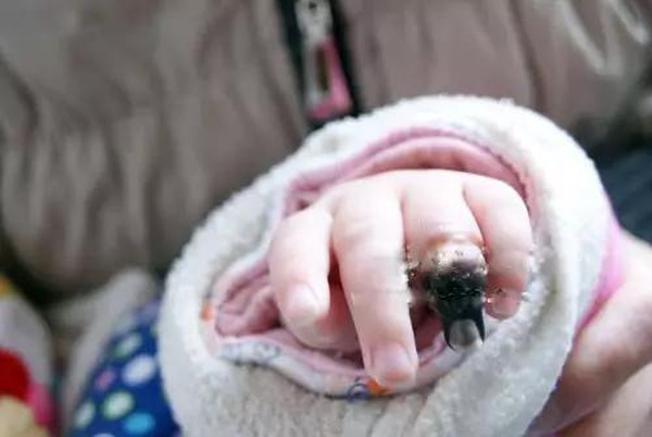 
Chỉ vì sơ cứu không đúng cách, ngón tay của của cháu bé có thể bị hoại tử nghiêm trọng (Ảnh: Internet)
