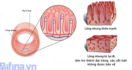 Hệ lông nhung dày đặc trong lòng đại tràng và bị trợ trụi nếu dùng nhiều kháng sinh