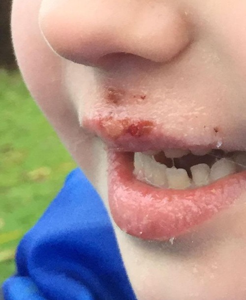 
Bà mẹ người Anh đã hoảng sợ khi phát hiện đôi môi của con gái 6 tuổi bị bỏng rộp, chảy máu

