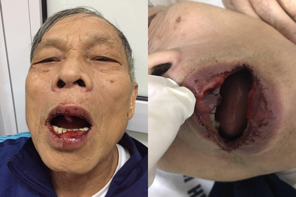 TS Nguyễn Khanh và vết thương sau khi bị chồng cô gái đánh.