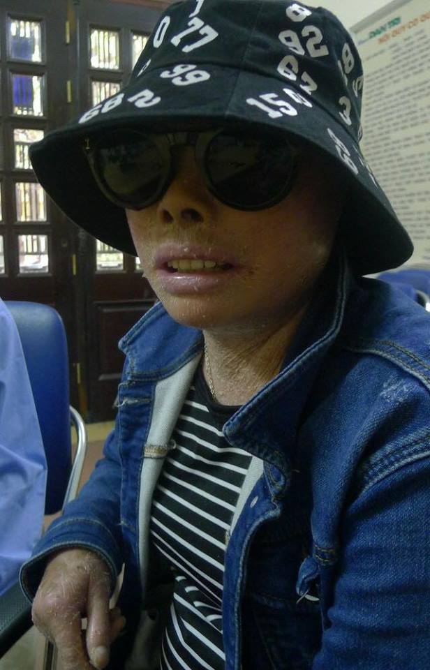 
Lâu nay, chị Lê Thị Hằng (29 tuổi, Quảng Bình) luôn mang bên mình một chiếc mũ to cùng cặp kính đen để giúp chị che đi phần nào cơ thể của mình trước ánh mắt người lạ. Ảnh: Nguyễn Bảo Ngọc
