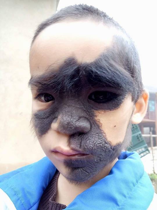 
Khi tròn18 tháng tuổi, Bảo Trọng được một tổ chức từ thiện đưa đi phẫu thuật tại Hà Nội. Việc phẫu thuật để bé có khuôn mặt bình thường đòi hỏi một hành trình dài. Ảnh: LB
