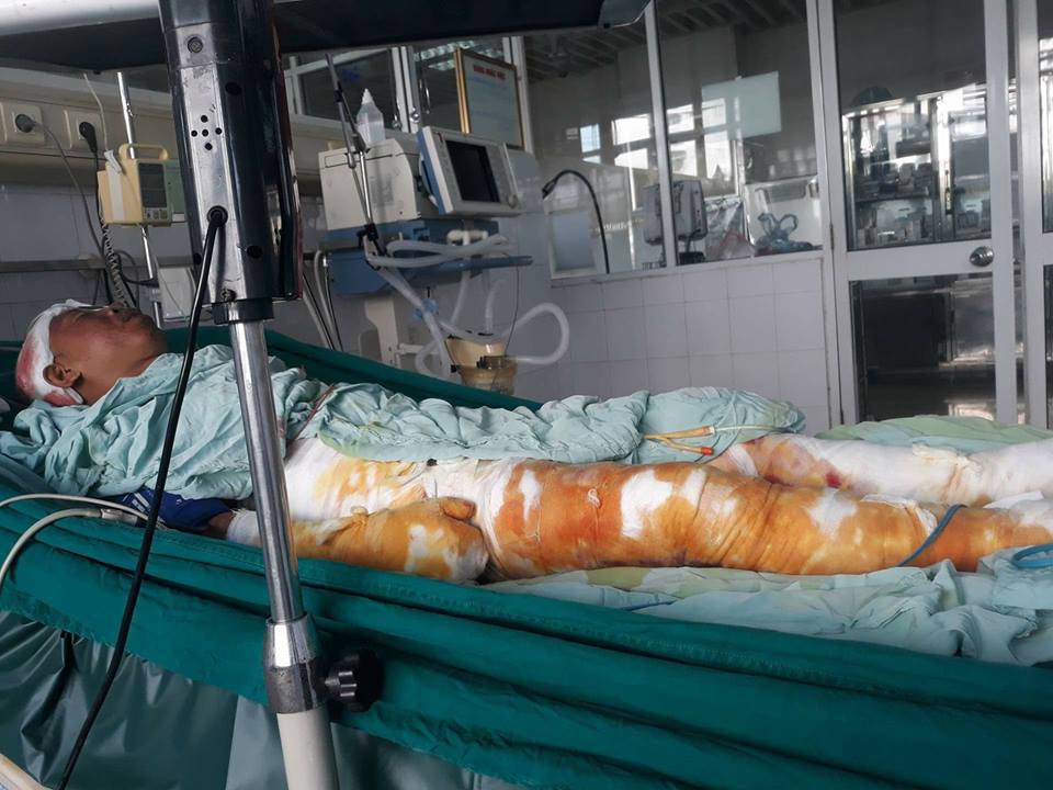 Đang là trụ cột gia đình chăm lo 2 em và phụng dưỡng bà nội giờ anh Hải phải nằm một chỗ do bỏng nặng. Ảnh: Sơn Nguyễn