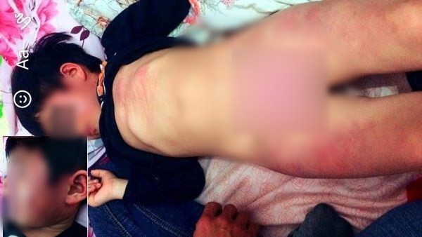 
Hình ảnh bé gái 4 tuổi bị đánh bầm tím tại trường mầm non xã Ngọc Sơn, Hiệp Hòa, Bắc Giang. Ảnh: Tư liệu
