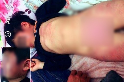 
Hình ảnh bé gái 4 tuổi bị đánh bầm tím tại trường mầm non ở Hiệp Hòa, Bắc Giang. Ảnh: Tư liệu
