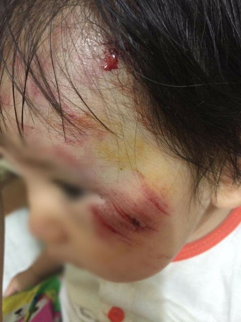 
Cháu bé 11 tháng tuổi bị trầy xước má sau vụ va chạm.

