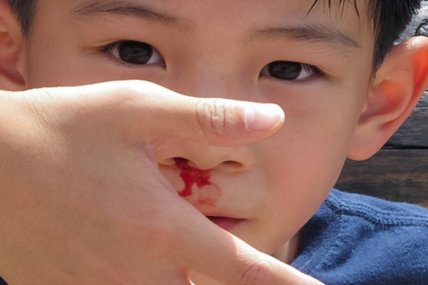 
Các chuyên gia khuyến cáo, không nên cho trẻ ngửa cổ lên hoặc cúi gằm xuống khi đang bị chảy máu cam. Ảnh minh họa
