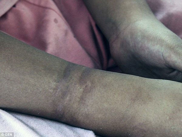 
Những vết thương do bị xiềng xích hằn lên cổ tay cô bé 13 tuổi.
