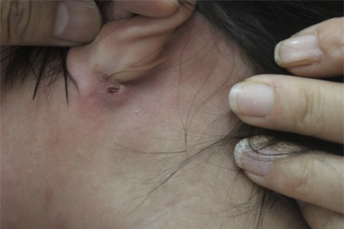 Hình ảnh nốt mò đốt sau vành tai của một bệnh nhân ở Nghệ An. Ảnh: P.C