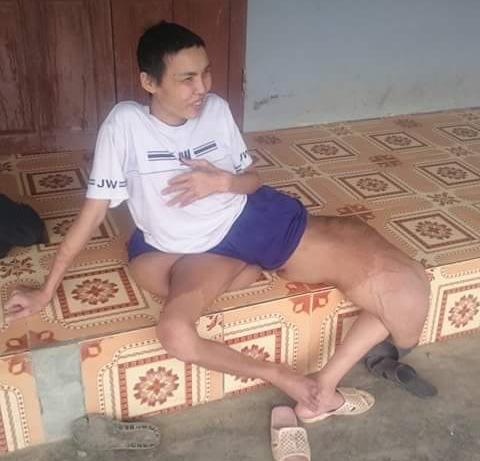 Anh Nguyễn Văn Sơn suốt 7 năm phải mang trên mình chân “voi” nặng bằng 1/2 trọng lượng cơ thể. Ảnh: T.G