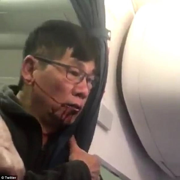 
Khuôn mặt vị bác sĩ gốc Á bị nhân viên an ninh hàng không đánh bầm dập.
