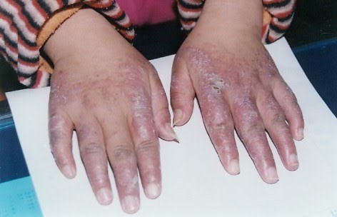 
Mùa lạnh, nhiều người thường bị ngứa da, cước chân tay
