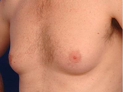 
Nam giới cũng có nguy cơ mắc chứng phù đại tuyến vú. Ảnh minh họa
