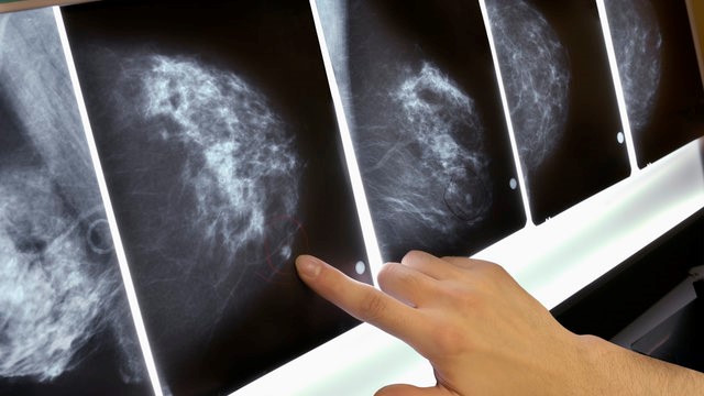 Ung thư vú được nhận biết sớm có tỷ lệ khỏi rất cao. Ảnh: Gettyimages.