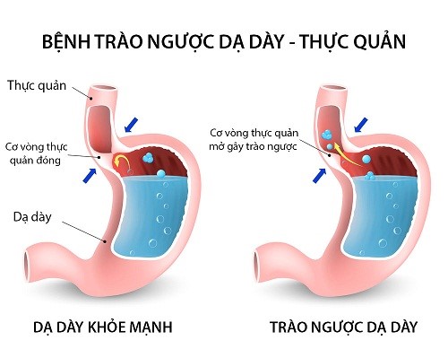 Thay đổi một số thói quen sinh hoạt cũng giúp ngăn ngừa tình trạng ợ nóng, trào ngược axit. Ảnh: bacsidaday.com.