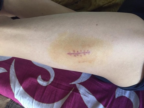 Vết thương của anh Cường (Ảnh nh&acirc;n vật cung cấp)