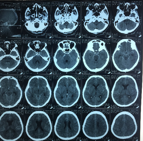 CT Scan sọ não có xuất huyết khoang dưới nhện và bao trước cầu não.