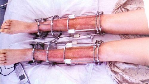 
Sau phẫu thuật, bộ khung kim loại được bắt vít vào xương khiến bệnh nhân phải chịu cảm giác đau đớn trong một khoảng thời gian khá dài. Ảnh: News.
