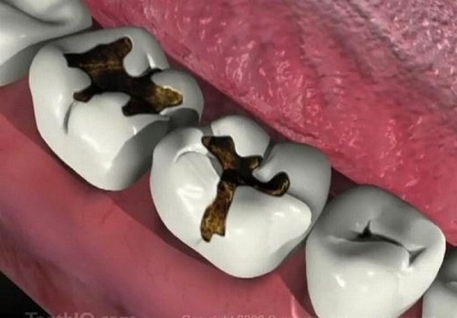 Nếu không thăm khám kịp thời, vùng răng bị đau sẽ gây ổ áp xe nguy hiểm đến tính mạng. (Ảnh minh họa)