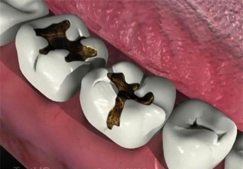 Nếu không thăm khám kịp thời, vùng răng bị đau sẽ gây ổ áp xe nguy hiểm đến tính mạng. (Ảnh minh họa)