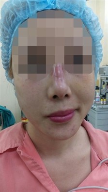 Chị T. sau khi điều trị nhiễm trùng nhưng mũi vẫn còn tổn thương.