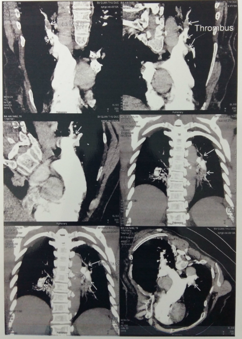 Hình ảnh huyết khối trong các nhánh động mạch phổi bệnh nhân. Ảnh: B.N